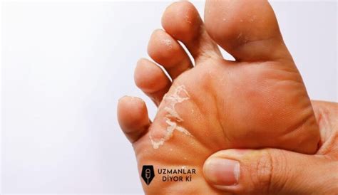 ayak parmakları arasında deri soyulması